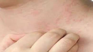 Photo of تعرف على أسباب حساسية الجلد المفاجئة