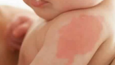 Photo of أمراض جلدية تصيب الأطفال.. تعرف عليها