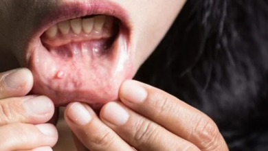 Photo of علامات صادمة تشير إلى إصابتك بسرطان الفم