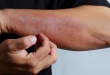 Photo of أعراض جديدة لفيروس كورونا تظهر على الجلد