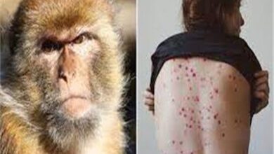Photo of وزارة الصحة تعلن الكشف عن حالة إصابة بفيروس جدري القرود
